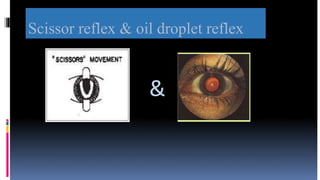 Scissor reflex & oil droplet reflex
&
 