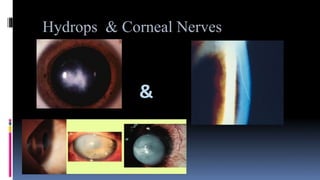 Hydrops & Corneal Nerves
&
 
