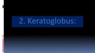 2. Keratoglobus:
 