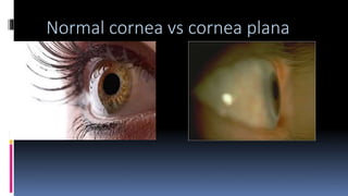 Normal cornea vs cornea plana
 