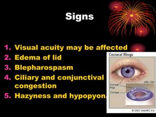 1. Visual acuity may be affected
2. Edema of lid
3. Blepharospasm
4. Ciliary and conjunctival
congestion
5. Hazyness and hypopyon.
Signs
 