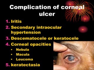 1. Iritis
2. Secondary intraocular
hypertension
3. Descematocele or keratocele
4. Corneal opacities
• Nebula
• Macula
• Leucoma
5. keratectasia
Complication of corneal
ulcer
 