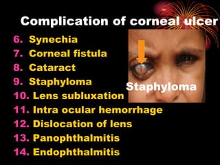 6. Synechia
7. Corneal fistula
8. Cataract
9. Staphyloma
10. Lens subluxation
11. Intra ocular hemorrhage
12. Dislocation of lens
13. Panophthalmitis
14. Endophthalmitis
Complication of corneal ulcer
Staphyloma
 