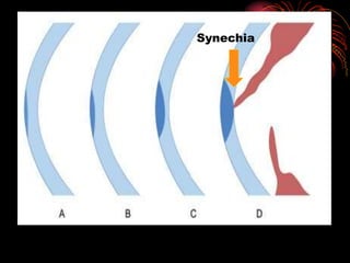 Synechia
 