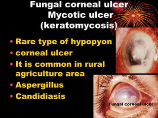 • Rare type of hypopyon
• corneal ulcer
• It is common in rural
agriculture area
• Aspergillus
• Candidiasis
Fungal corneal ulcer
Mycotic ulcer
(keratomycosis)
Fungal corneal ulcer
 