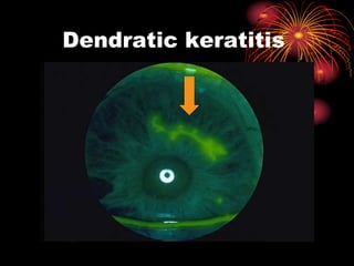 Dendratic keratitis
 