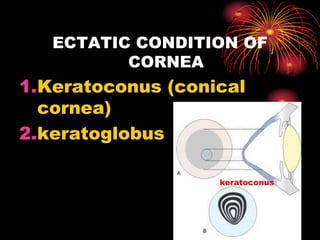 ECTATIC CONDITION OF
CORNEA
1.Keratoconus (conical
cornea)
2.keratoglobus
keratoconus
 