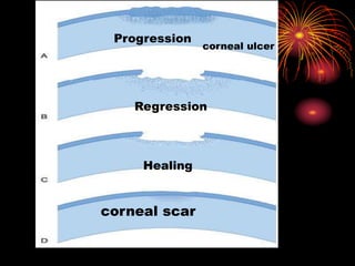 Progression
corneal ulcer
Regression
Healing
corneal scar
 