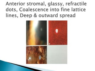 Corneal Dystrophies | PPT