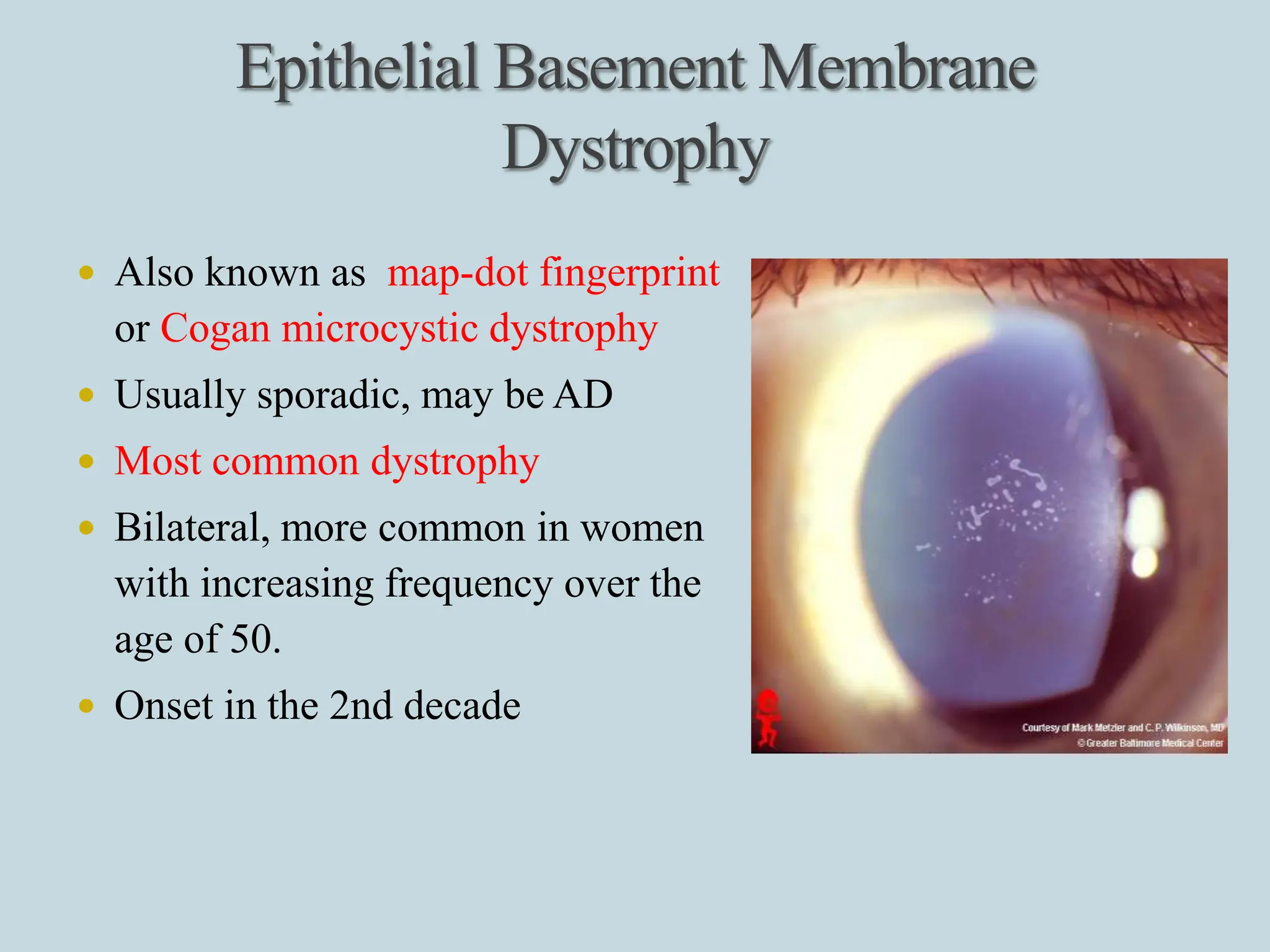 CORNEAL DYSTROPHIES PRESENTATION IN OPTOMETRIST PERSPECTIVE | PPTX