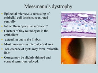 CORNEAL DYSTROPHIES PRESENTATION IN OPTOMETRIST PERSPECTIVE | PPTX