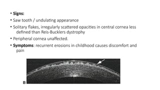 corneal dystrophies detailed seminar (1).pptx