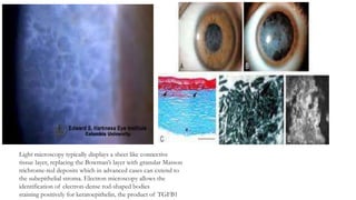 Light microscopy typically displays a sheet like connective
tissue layer, replacing the Bowman’s layer with granular Masson
trichrome-red deposits which in advanced cases can extend to
the subepithelial stroma. Electron microscopy allows the
identification of electron-dense rod-shaped bodies
staining positively for keratoepithelin, the product of TGFB1
 