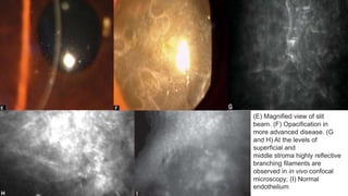 (E) Magnified view of slit
beam. (F) Opacification in
more advanced disease. (G
and H) At the levels of
superficial and
middle stroma highly reflective
branching filaments are
observed in in vivo confocal
microscopy; (I) Normal
endothelium
 