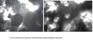 In vivo confocal microscopy; showing large hyper-reflective opacities
 