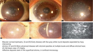 Figs
Macular corneal dystrophy: (A and B) Early disease with few gray white round deposits separated by hazy
intervening
stroma; (C and D) More advanced disease with stromal opacities at multiple levels and diffuse stromal haze;
(E) Slit beam view; (F) Highly
reflective deposits seen in the superficial stroma, in confocal microscopy
 