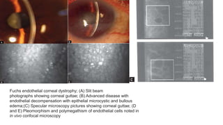 Fuchs endothelial corneal dystrophy; (A) Slit beam
photographs showing corneal guttae; (B) Advanced disease with
endothelial decompensation with epithelial microcystic and bullous
edema;(C) Specular microscopy pictures showing corneal guttae; (D
and E) Pleomorphism and polymegathism of endothelial cells noted in
in vivo confocal microscopy
 