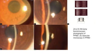 (A to D) Slit-lamp
biomicroscopic
photographs of
PPMD. (E) Specular
microscopy in PPMD
 