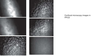 Confocal microscopy images in
PPCD
 