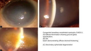 Congenital hereditary endothelial dystrophy CHED 2;
(A) Diffuse illumination showing ground glass
opacification;
(B) Slit
beam demonstrating diffuse stromal thickening;
(C) Secondary spheroidal degeneration
 