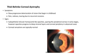 Thiel-Behnke Corneal dystrophy
▪ Symptoms
 Slow progressive deterioration of vision that begin in childhood
 Pain, redness, tearing due to recurrent erosions
▪ Signs
 Subepithelial reticular honeycomb like opacities, sparing the peripheral cornea in early stages,
however opacities progress to deep stromal layers and corneal periphery in advanced cases
 Corneal sensations are typically normal
 