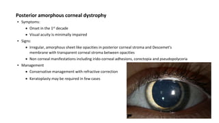 Posterior amorphous corneal dystrophy
▪ Symptoms:
 Onset in the 1st decade
 Visual acuity is minimally impaired
▪ Signs:
 Irregular, amorphous sheet like opacities in posterior corneal stroma and Descemet’s
membrane with transparent corneal stroma between opacities
 Non corneal manifestations including irido-corneal adhesions, corectopia and pseudopolycoria
▪ Management
 Conservative management with refractive correction
 Keratoplasty may be required in few cases
 