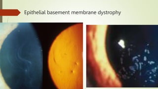 CORNEAL DYSTROPHY and degen.pptx