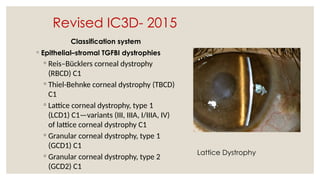 Revised IC3D- 2015
Classification system
◦ Epithelial–stromal TGFBI dystrophies
◦ Reis–Bücklers corneal dystrophy
(RBCD) C1
◦ Thiel-Behnke corneal dystrophy (TBCD)
C1
◦ Lattice corneal dystrophy, type 1
(LCD1) C1—variants (III, IIIA, I/IIIA, IV)
of lattice corneal dystrophy C1
◦ Granular corneal dystrophy, type 1
(GCD1) C1
◦ Granular corneal dystrophy, type 2
(GCD2) C1
Lattice Dystrophy
 