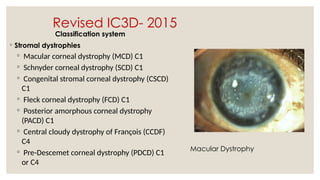Revised IC3D- 2015
Classification system
◦ Stromal dystrophies
◦ Macular corneal dystrophy (MCD) C1
◦ Schnyder corneal dystrophy (SCD) C1
◦ Congenital stromal corneal dystrophy (CSCD)
C1
◦ Fleck corneal dystrophy (FCD) C1
◦ Posterior amorphous corneal dystrophy
(PACD) C1
◦ Central cloudy dystrophy of François (CCDF)
C4
◦ Pre-Descemet corneal dystrophy (PDCD) C1
or C4
Macular Dystrophy
 
