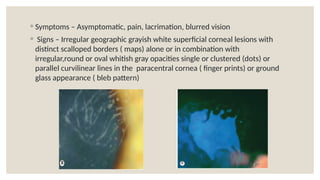 ◦ Symptoms – Asymptomatic, pain, lacrimation, blurred vision
◦ Signs – Irregular geographic grayish white superficial corneal lesions with
distinct scalloped borders ( maps) alone or in combination with
irregular,round or oval whitish gray opacities single or clustered (dots) or
parallel curvilinear lines in the paracentral cornea ( finger prints) or ground
glass appearance ( bleb pattern)
 