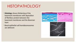 HISTOPATHOLOGY
◦ Histology shows thickening of the
basement membrane with deposition
of fibrillary protein between the
basement membrane and the Bowman
layer.
◦ Basal epithelial cell hemidesmosomes
are deficient
 