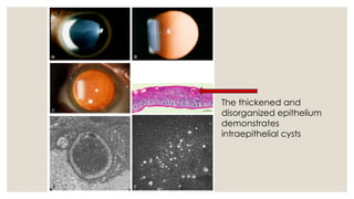 The thickened and
disorganized epithelium
demonstrates
intraepithelial cysts
 