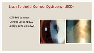 Lisch Epithelial Corneal Dystrophy (LECD)
◦ X linked dominant
Genetic Locus Xp22.3
Specific gene unknown
 