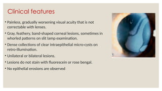 Clinical features
• Painless, gradually worsening visual acuity that is not
correctable with lenses.
• Gray, feathery, band-shaped corneal lesions, sometimes in
whorled patterns on slit lamp examination.
• Dense collections of clear intraepithelial micro-cysts on
retro-illumination.
• Unilateral or bilateral lesions.
• Lesions do not stain with fluorescein or rose bengal.
• No epithelial erosions are observed
 