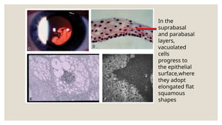In the
suprabasal
and parabasal
layers,
vacuolated
cells
progress to
the epithelial
surface,where
they adopt
elongated flat
squamous
shapes
 