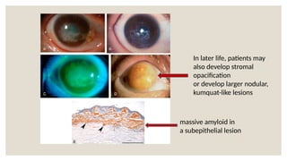 In later life, patients may
also develop stromal
opacification
or develop larger nodular,
kumquat-like lesions
massive amyloid in
a subepithelial lesion
 
