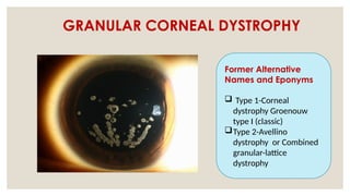 GRANULAR CORNEAL DYSTROPHY
Former Alternative
Names and Eponyms
 Type 1-Corneal
dystrophy Groenouw
type I (classic)
Type 2-Avellino
dystrophy or Combined
granular-lattice
dystrophy
 