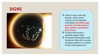 SIGNS
 Onset is early in life with
discrete white central
anterior stromal deposits
resembling resembling sugar
granules or breadcrumbs or
glass splinters separated by
clear stroma
 On direct illumination-
opacities appear white
 On indirect illumination-small
translucent dots with vacuoles
and glassy splinters or crushed
bread crumb appearance
 