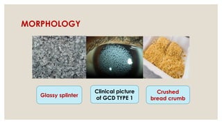MORPHOLOGY
Glassy splinter
Clinical picture
of GCD TYPE 1
Crushed
bread crumb
 