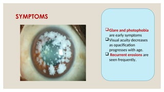 SYMPTOMS
Glare and photophobia
are early symptoms
Visual acuity decreases
as opacification
progresses with age.
 Recurrent erosions are
seen frequently.
 