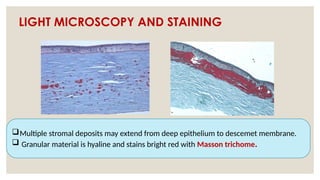 LIGHT MICROSCOPY AND STAINING
Multiple stromal deposits may extend from deep epithelium to descemet membrane.
 Granular material is hyaline and stains bright red with Masson trichome.
 