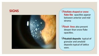 SIGNS Stellate shaped or snow
flake like opacities appear
between anterior and mid
stroma
Dash lines also present
deeper than snow flake
opacities.
Hyaloid deposits typical of
granular and amyloid
deposits typical of lattice
seen.
 