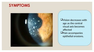 SYMPTOMS
Vision decreases with
age as the central
visual axis becomes
affected
Pain accompanies
epithelial erosions.
 