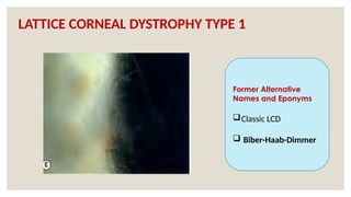 LATTICE CORNEAL DYSTROPHY TYPE 1
Former Alternative
Names and Eponyms
Classic LCD
 Biber-Haab-Dimmer
 
