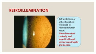 RETROILLUMINATION
Refractile lines or
lattice lines best
visualised in
retroillumination
mode.
These lines start
centrally and
superficially and
spread centrifugally
and deeper.
 