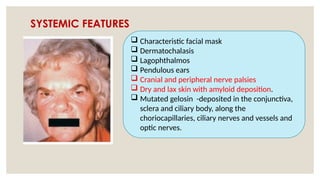 SYSTEMIC FEATURES
 Characteristic facial mask
 Dermatochalasis
 Lagophthalmos
 Pendulous ears
 Cranial and peripheral nerve palsies
 Dry and lax skin with amyloid deposition.
 Mutated gelosin -deposited in the conjunctiva,
sclera and ciliary body, along the
choriocapillaries, ciliary nerves and vessels and
optic nerves.
 