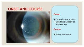 ONSET AND COURSE
Onset
Cornea is clear at birth
Cloudiness appears at
3-9yrs of age
Course
Slowly progressive
 