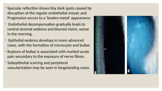 ◦ Specular reflection shows tiny dark spots caused by
disruption of the regular endothelial mosaic and
Progression occurs to a ‘beaten metal’ appearance
◦ Endothelial decompensation gradually leads to
central stromal oedema and blurred vision, worse
in the morning.
◦ Epithelial oedema develops in more advanced
cases, with the formation of microcysts and bullae
◦ Rupture of bullae is associated with marked acute
pain secondary to the exposure of nerve fibres.
◦ Subepithelial scarring and peripheral
vascularization may be seen in longstanding cases.
 