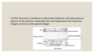 ◦ In FECD, Descemet’s membrane is abnormally thickened, with attenuation or
absence of the posterior nonbanded zone and replacement with abnormal
collagen, known as wide-spaced collagen
 