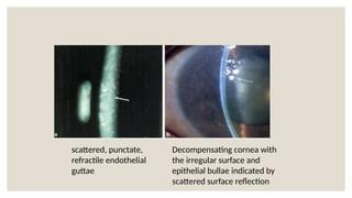 scattered, punctate,
refractile endothelial
guttae
Decompensating cornea with
the irregular surface and
epithelial bullae indicated by
scattered surface reflection
 